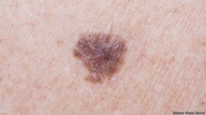 151019034457_mole_skin_cancer_624x351_sciencephotolibrary